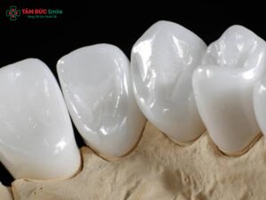 Các loại răng sứ Cercon phổ biến và ưu nhược điểm chi tiết