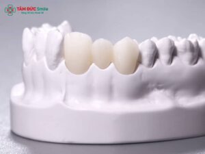 Răng sứ Cercon của nước nào? Ưu điểm và xuất xứ chính hãng