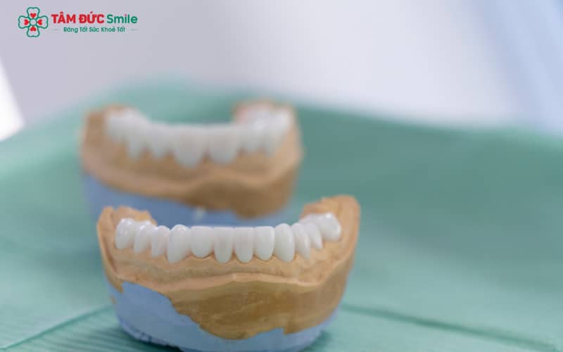 Răng sứ vẫn có thể bị mòn theo thời gian do lực nhai, thói quen sinh hoạt và chất lượng vật liệu