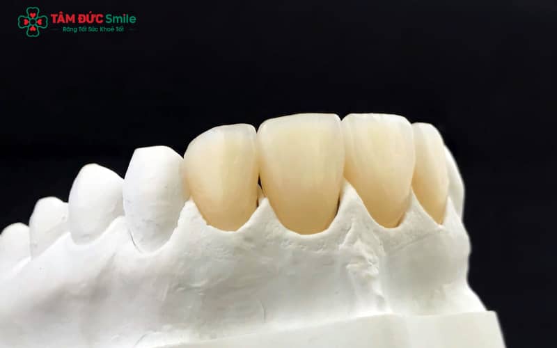 Răng sứ bị mòn do lực nhai mạnh, nghiến răng, vệ sinh sai cách hoặc sử dụng vật liệu kém chất lượng