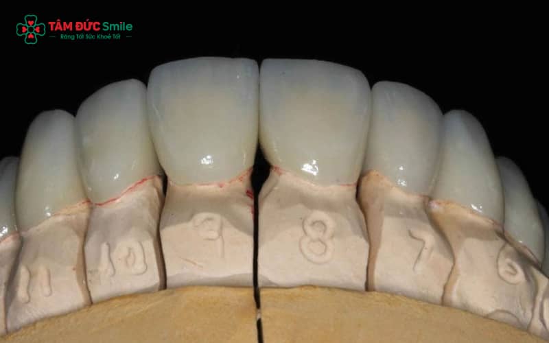 Răng sứ Crom Coban gồm sườn Crom–Coban chắc chắn và lớp sứ phủ giúp phục hình bền, ít gây kích ứng
