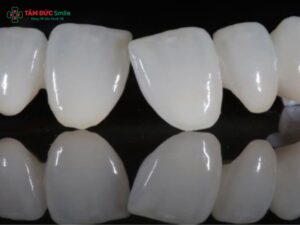 Răng sứ Emax Press là gì? Bảng giá, ưu điểm & tuổi thọ