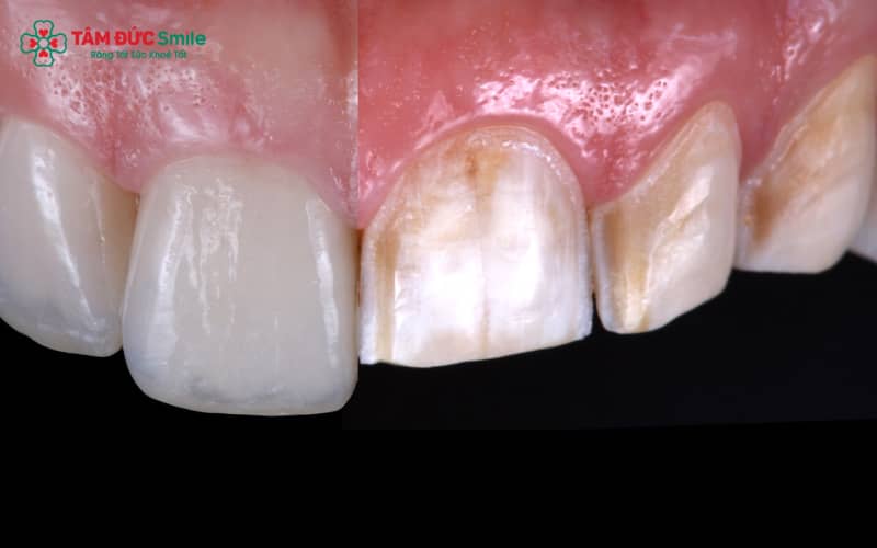 Răng sứ có tuổi thọ trung bình từ 7–15 năm tùy vào chất lượng và cách chăm sóc