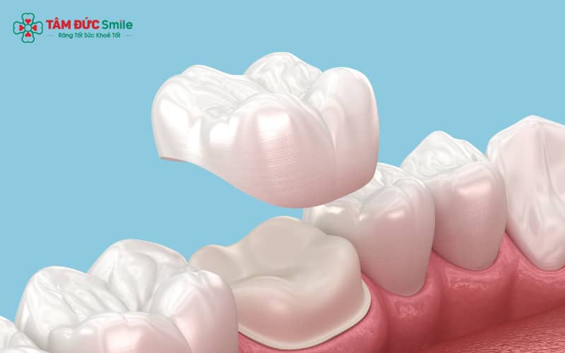 Thói quen ăn uống, hút thuốc và chăm sóc răng không đúng cách khiến răng sứ nhanh xuống cấp