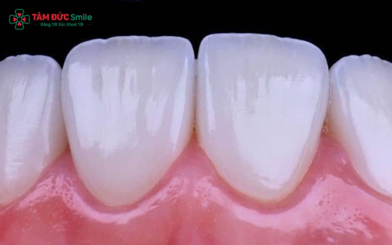 Tuổi thọ răng sứ thay đổi theo vật liệu – răng toàn sứ cao cấp có thể bền đến hơn 15 năm