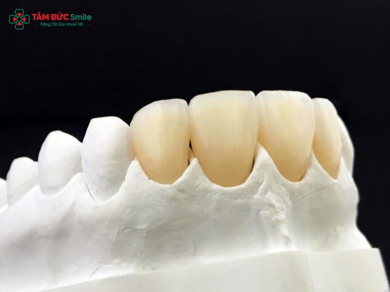 Răng sứ không kim loại là gì? Ưu điểm và quy trình tại Tâm Đức Smile