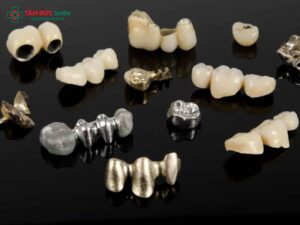 Răng sứ kim loại Ni-Cr là gì? Cấu tạo, ưu nhược điểm và độ bền