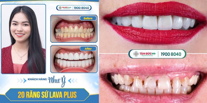 Răng sứ Lava được chế tác từ phôi zirconia nguyên khối, ứng dụng công nghệ CAD/CAM tiên tiến mang lại độ chính xác