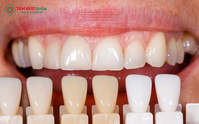 “Cấu tạo răng sứ Mỹ: độ trong mờ tự nhiên, chất liệu sứ cao cấp giúp đảm bảo thẩm mỹ và độ bền