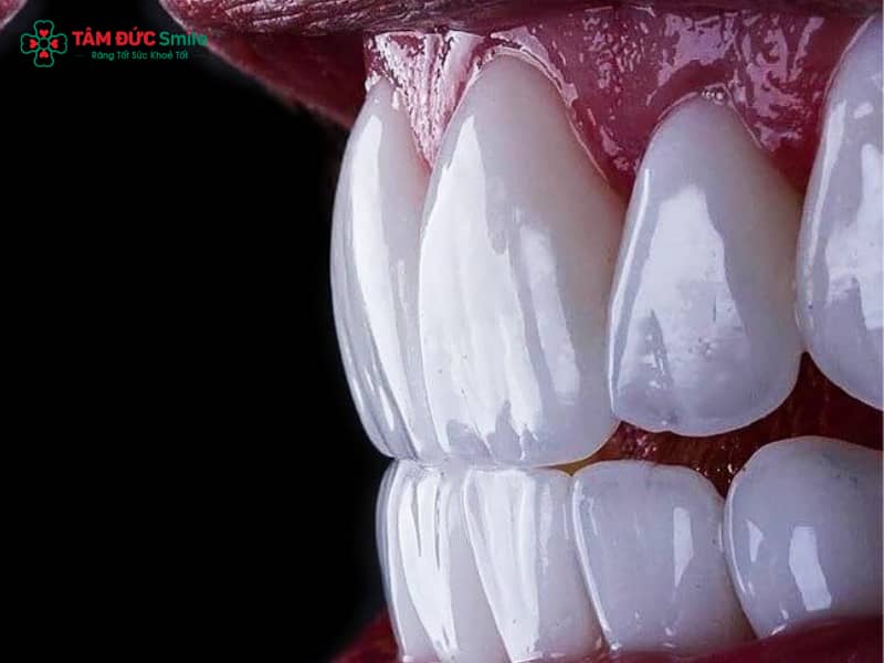 Răng sứ Mỹ có tốt không? Ưu điểm, độ bền, màu sắc và cấu tạo chi tiết