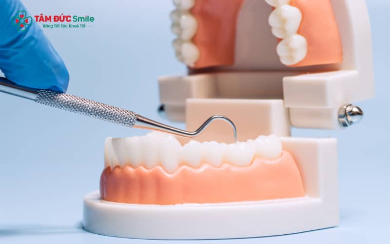 Răng sứ tháo lắp là dạng phục hình răng có thể tháo ra – lắp vào dễ dàng, giúp khôi phục chức năng ăn nhai và thẩm m