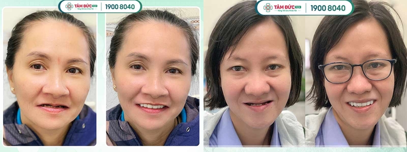 Răng sứ tháo lắp được chia theo phạm vi phục hình và chất liệu, đáp ứng nhu cầu đa dạng của người dùng