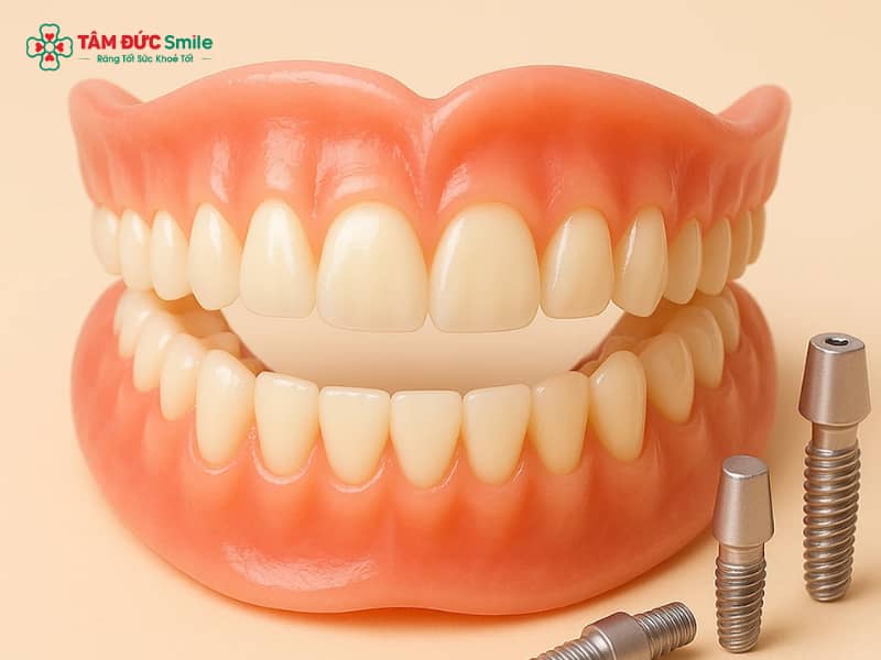 Răng sứ tháo lắp là gì? Cấu tạo và ưu nhược điểm