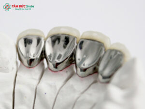 Răng sứ Titan giá bao nhiêu? Bảng giá, ưu nhược điểm và độ bền mới nhất