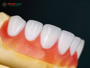 Răng sứ Venus có mấy loại? Phân biệt Venus Titan, toàn sứ, Pearl