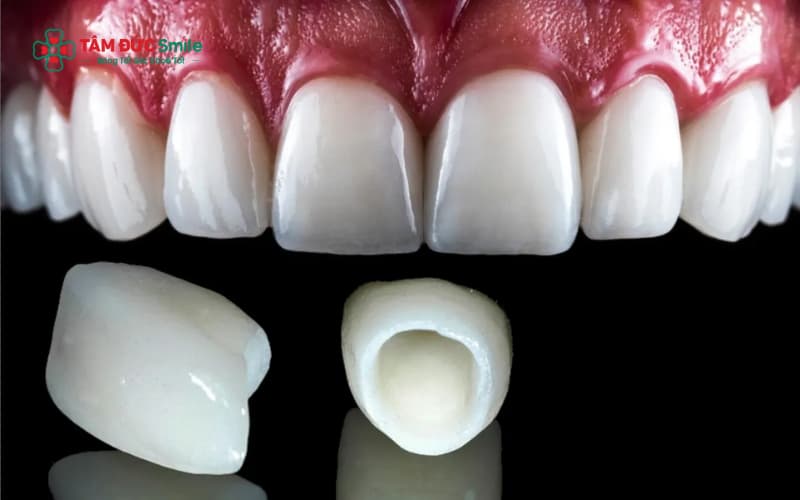 Răng sứ Zirconia Hàn Quốc là dòng răng sứ cao cấp với độ trắng trong tự nhiên, đạt tiêu chuẩn thẩm mỹ