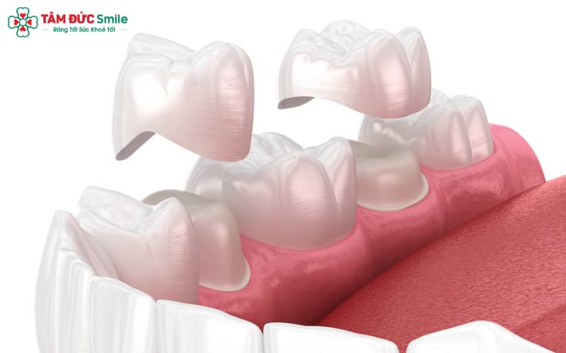 Sau khi bọc răng sứ nên làm gì – Việc chăm sóc đúng cách giúp duy trì thẩm mỹ, bảo vệ nướu và tăng tuổi thọ cho răng sứ