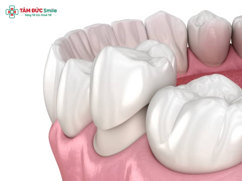 Sau khi bọc răng sứ nên làm gì? Hướng dẫn chăm sóc răng sứ đúng cách