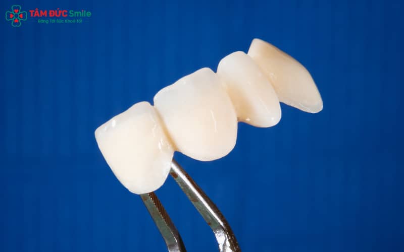 Dấu hiệu cần thay răng sứ: hở cổ, nứt mẻ, đổi màu, nướu viêm và răng sứ bị lệch khớp cắn