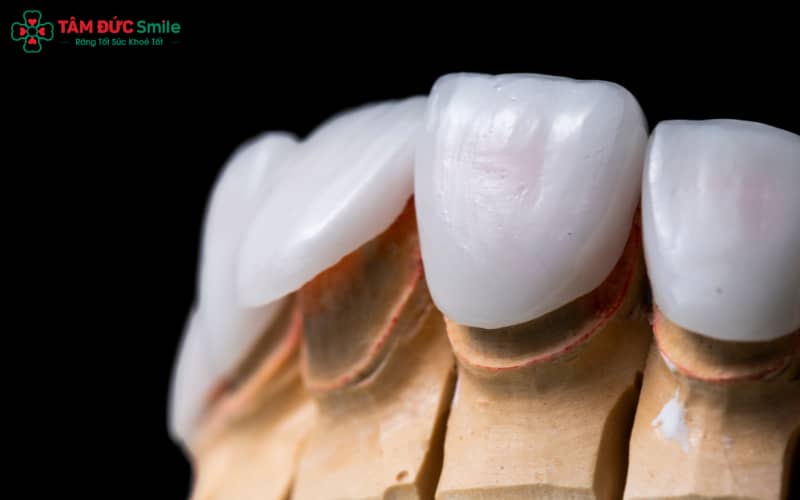 Răng sứ hư sớm do kỹ thuật phục hình không chuẩn, vật liệu kém hoặc thói quen vệ sinh – ăn uống sai cách