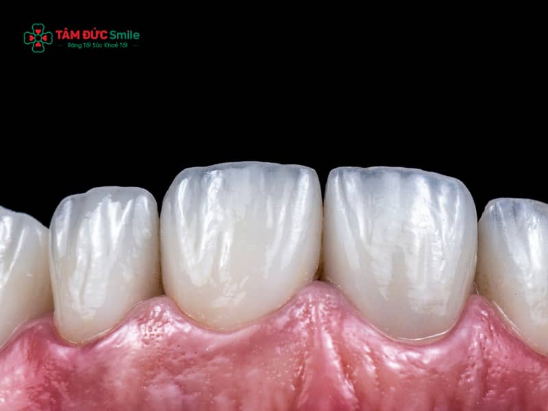 Dấu hiệu nhận biết khi nào cần thay răng sứ để bảo vệ răng thật