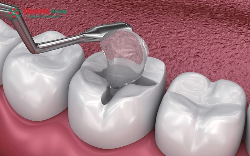 Với kỹ thuật hiện đại và thuốc tê hỗ trợ, quá trình trám răng tại Nha khoa Tâm Đức Smile diễn ra nhẹ nhàng, hạn chế tối đa cảm giác đau nhức hay khó chịu.