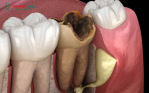 Trồng răng hàm gần như không đau nhờ gây tê hiện đại và thao tác chuẩn xác của bác sĩ