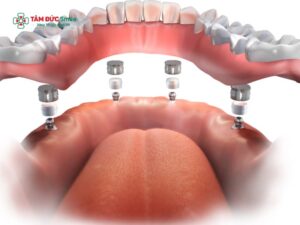 Trồng răng Implant 4S là gì? Công nghệ 4S an toàn, nhanh, bền, đẹp