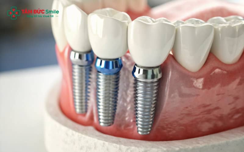 Trồng răng implant giúp người cao tuổi ăn nhai tự nhiên, ngăn tiêu xương, tăng tuổi thọ răng và cải thiện thẩm mỹ nụ cười.