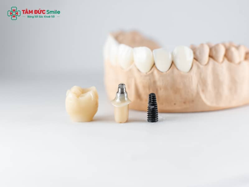 Trồng răng Implant cho người cao tuổi an toàn, bền đẹp tại Nha khoa Tâm Đức Smile