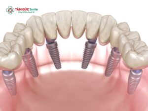 Trồng răng Implant có bị hôi miệng không? Nguyên nhân viêm, mùi và cách xử lý