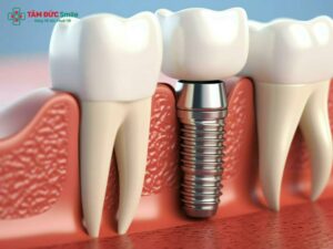 Trồng răng Implant có vĩnh viễn không? Tuổi thọ, độ bền và cách chăm sóc