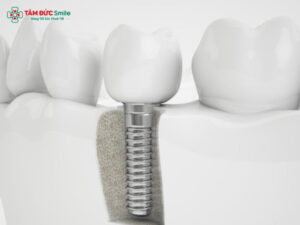 Trồng răng Implant Hàn Quốc giá bao nhiêu? Bảng giá tại Tâm Đức Smile