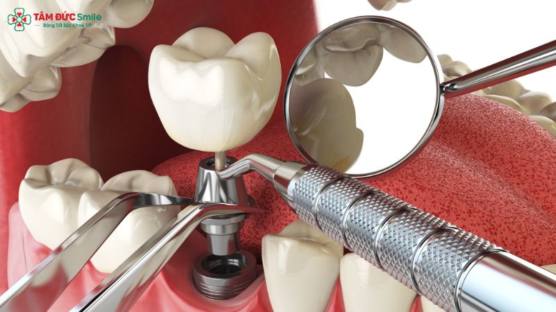 Cấu tạo răng Implant gồm trụ Implant, khớp nối Abutment và mão răng sứ – Nha khoa Tâm Đức Smile.