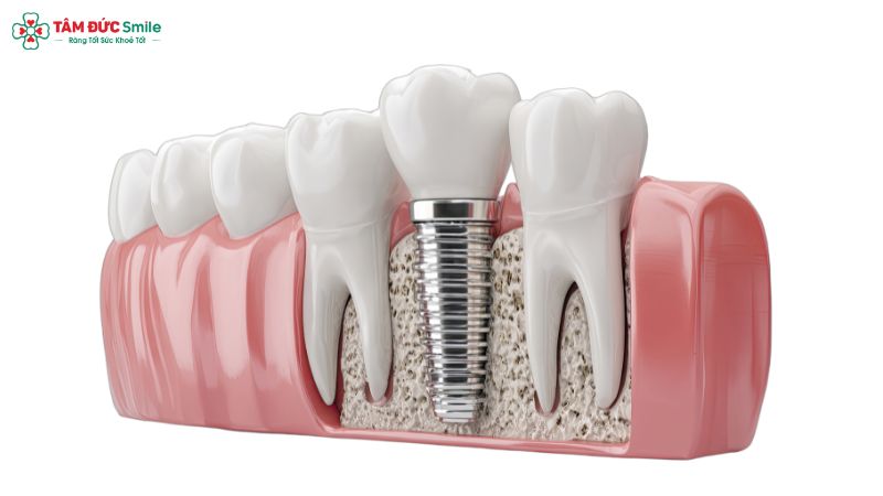 Trồng răng Implant giúp phục hồi răng mất, cải thiện ăn nhai và bảo tồn răng thật kế cận – Nha khoa Tâm Đức Smile.