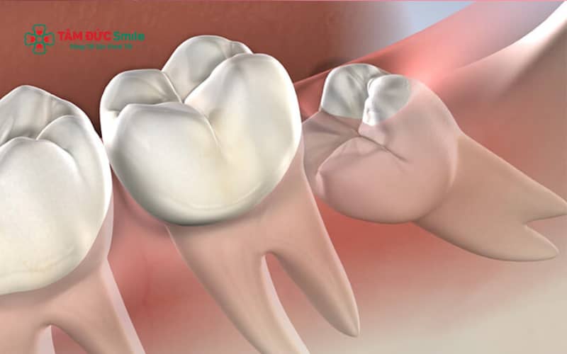 Răng khôn mọc ở tuổi 30 thường tiềm ẩn nguy cơ biến chứng cao hơn do xương hàm đã cứng và khoảng trống mọc răng hạn chế