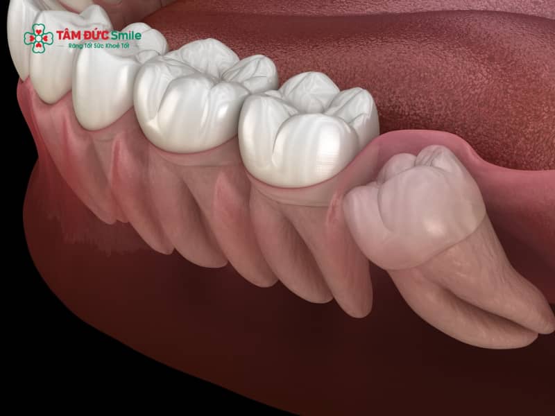Mọc răng khôn ở tuổi 30 có nguy hiểm không? Nên nhổ hay giữ răng khôn