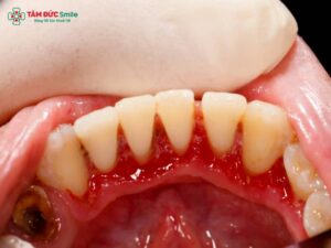 Cách điều trị cho bà bầu bị viêm nha chu an toàn, hiệu quả