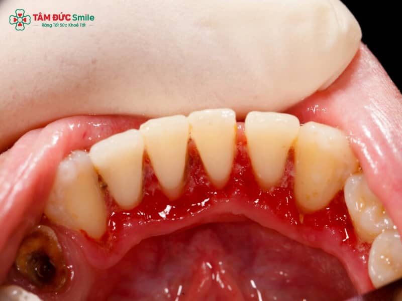 Cách điều trị cho bà bầu bị viêm nha chu an toàn, hiệu quả