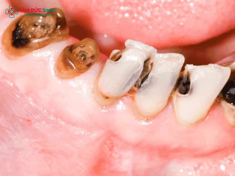 Bé 5 tuổi bị sâu răng cấm: Nguyên nhân, dấu hiệu và cách điều trị hiệu quả