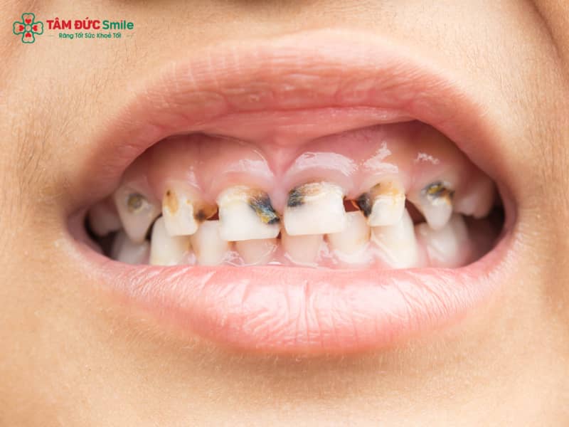 Bé 5 tuổi bị sâu răng hàm phải làm sao? Nguyên nhân, biểu hiện và cách xử lý cho trẻ