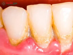 Bệnh viêm nha chu có lây không? Nguyên nhân, dấu hiệu và cách phòng ngừa hiệu quả