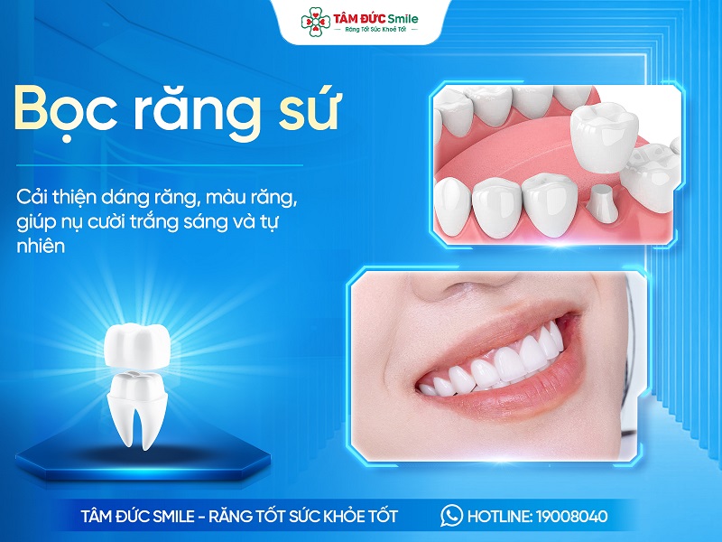 Bọc răng sứ là gì? Quy trình, Chi phí và Rủi ro cần biết