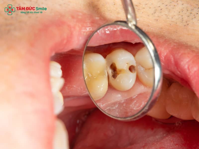 Các giai đoạn sâu răng: Dấu hiệu, nguyên nhân và cách điều trị hiệu quả