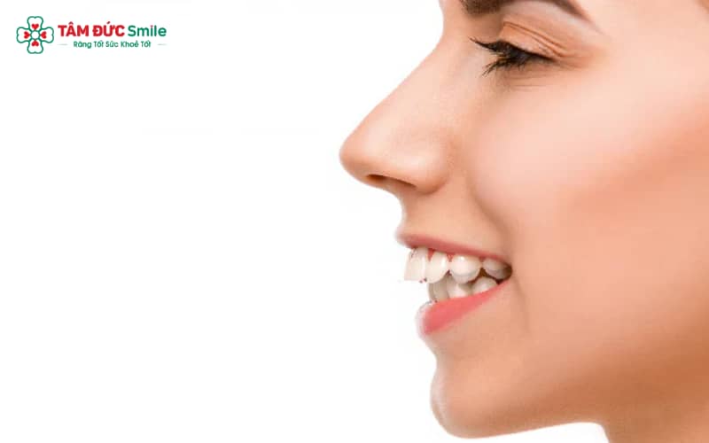 Ba kiểu răng hô phổ biến: hô do răng, hô do hàm và hô hỗn hợp – mỗi loại có cơ chế hình thành và cách điều trị khác nhau