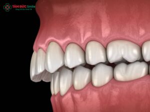 Các kiểu răng hô thường gặp: nguyên nhân, dấu hiệu, mức độ và cách điều trị hiệu quả