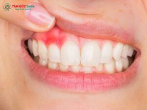 Cách chữa viêm nha chu răng tại nhà giảm sưng, chảy máu, tụt lợi an toàn hiệu quả