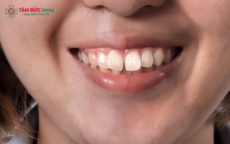 Các mẹo làm răng bớt hô tại nhà chỉ hỗ trợ thói quen và cơ môi – lưỡi, không thể thay đổi cấu trúc răng hoặc xương hàm