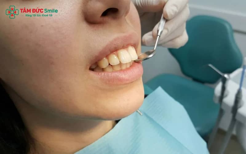 Các nguyên nhân gây hô phổ biến: di truyền, thói quen xấu, răng mọc lệch, bất cân xứng xương hàm và sai tư thế môi – lưỡi