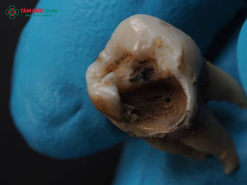 Cách trị sâu răng tại nhà bằng muối: súc miệng, giảm đau, chữa sâu răng nhẹ